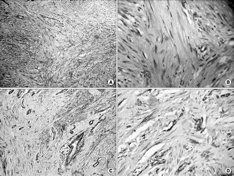 Figure 2 From A Case Of Fibrous Pseudotumor Of The Paratesticular