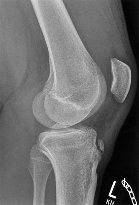 Osgood Schlatter Disease Knowledge Amboss 58 Off