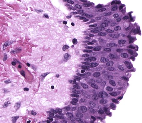 A Review Of The Cysts Of The Spleen Diagnostic Histopathology