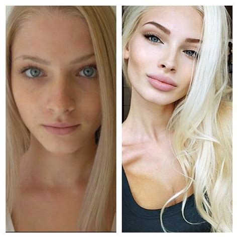 Alena Shishkova Before And After Botoxbrowlift Botoxresults Botox