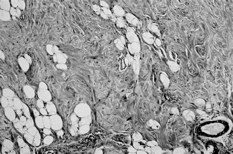 Monomorphic Proliferation Of Spindle Cells Organized In Bundles