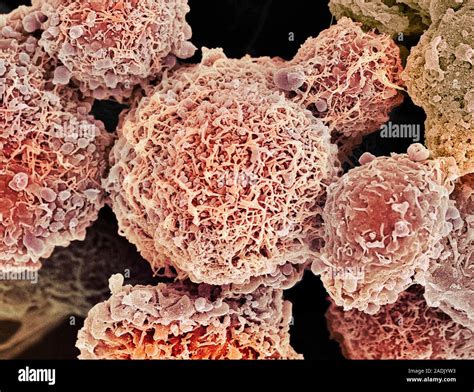 Cervical Cancer Cells Coloured Scanning Electron Micrograph Sem Of