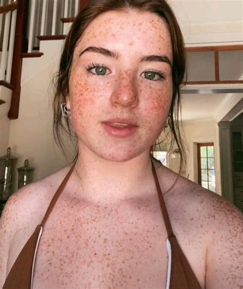 Freckled Freckles R Freckledgirls