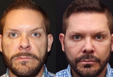 Cheekbone Implants Men Before And After