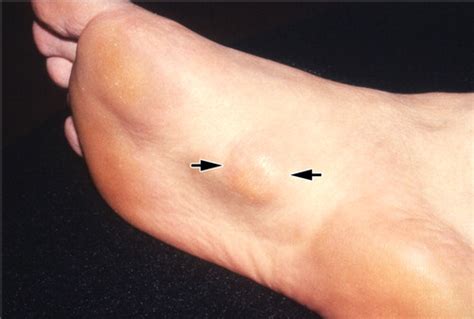 Musculoskeletal Fibromatoses Radiologic Pathologic Correlation Radiographics