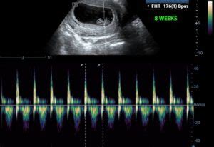 babys heart beat       babys gender