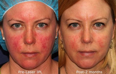 IPL Photofacial Treatments by San Diego Dermatology Experts