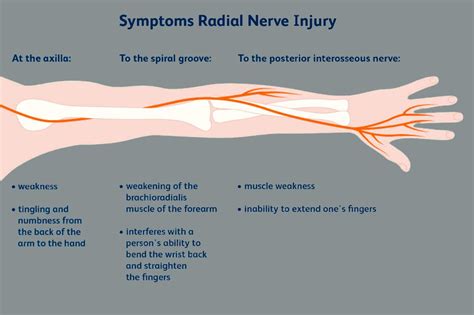 Radial Nerve Peripheral Upper Extremity Pushasrx Athletic Training