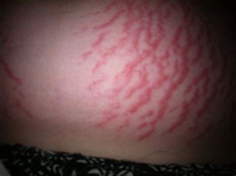 Infected Stretch Marks Pic Babycenter