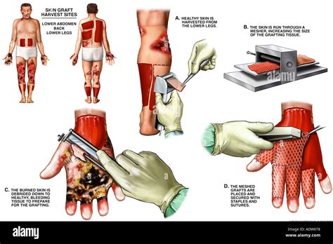 Graft Meaning