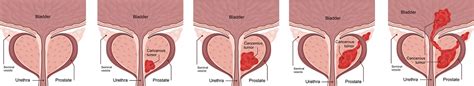 Medical Diagram Of 4 Stages Of Prostate Cancer Tumor Grows And