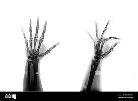 Oblique Orbit X Ray Positioning - masak