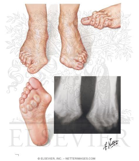 Forefoot Deformities In Rheumatoid Arthritis