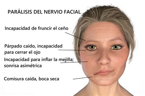 Tipos de parálisis facial, síntomas y opciones de tratamiento para