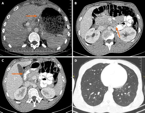 Figure From Primary Gastroduodenal Tuberculosis Presenting As Gastric