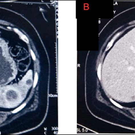 (A) Coronal section image of 68 Ga DOTATATE PET scan showing enhancing ...