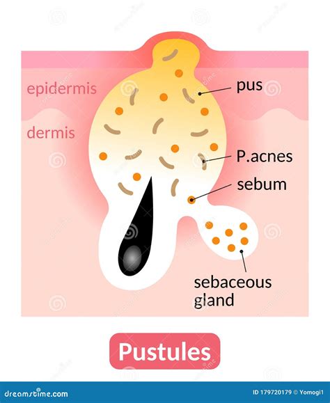 Pus Stock Illustrations – 767 Pus Stock Illustrations, Vectors ...