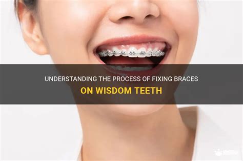 Understanding The Process Of Fixing Braces On Wisdom Teeth Medshun