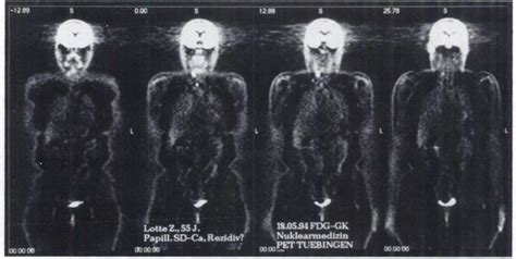 Uptake Pattern Type I In A 56 Yr Old Woman With Papillary Thyroid