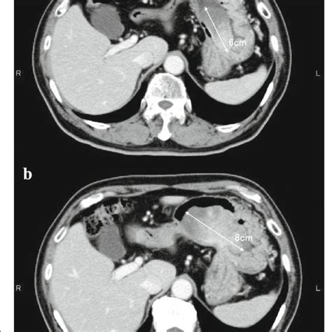 Abdominal Computed Tomography Ct Showed A 6 Cm Gastric Tumor In Early