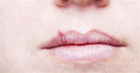 Oral And Genital Herpes Viruses Are Having Sex With Terrifying Consequences Mirror Online