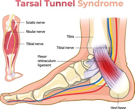 illustration of tarsal tunnel syndrome diagram 45993903 Vector Art at