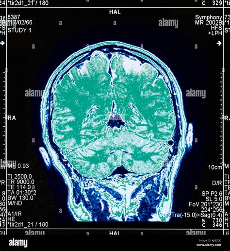 Mri brain scan hi-res stock photography and images - Alamy