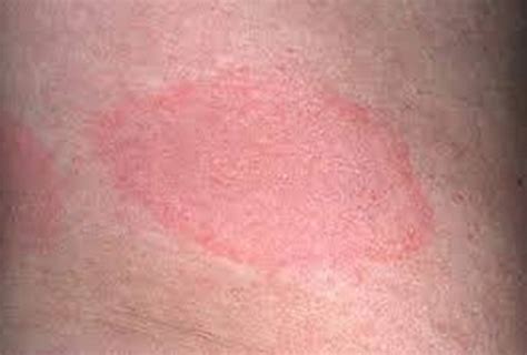 Lyme Disease Symptoms Rash