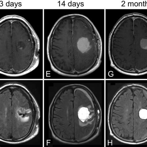 Representative Case 2 Preoperative Contrast Enhanced T1 Weighted A