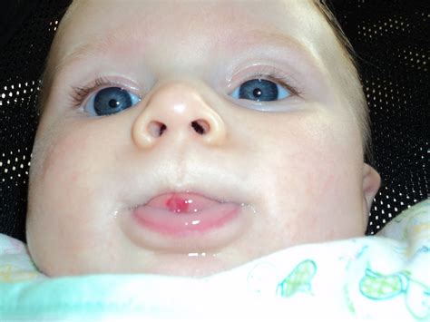 Hemangioma Newborn Pictures Photos