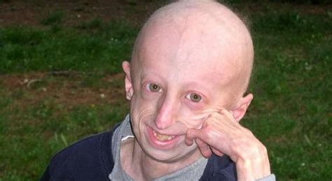 Progeria Cosa La Malattia Di Cui Soffre Sammy Basso Operato Al San