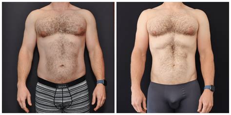 Liposuction Before And After Men