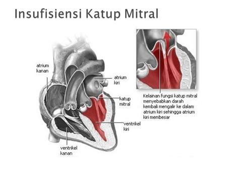 Demam reumatik & penyakit jantung rematik