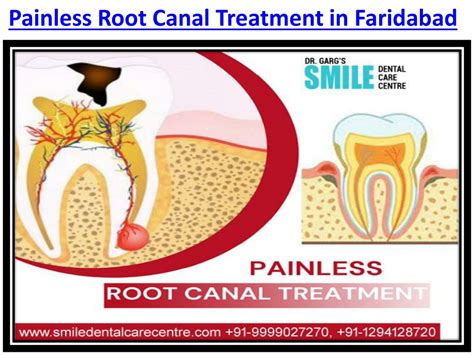 Ppt Can Painless Root Canal Treatment Procedure Be Performed In India