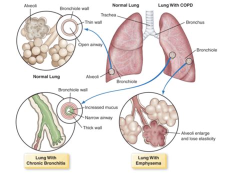 chapter 26: coordinating care for patients with lower airway disorders