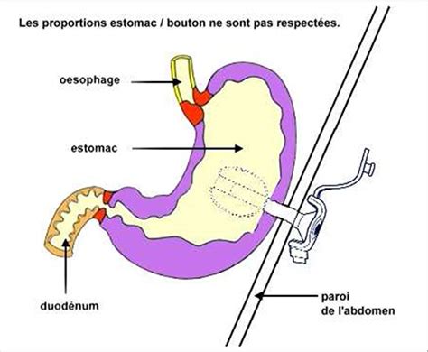 CEDI Fiche dinformation gastrostomie percutanée endoscopique