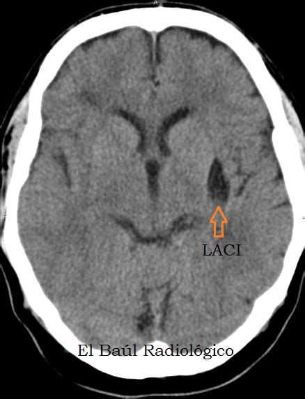 El Baúl Radiológico: ICTUS: UN GALIMATÍAS DE SIGLAS (Stroke: A