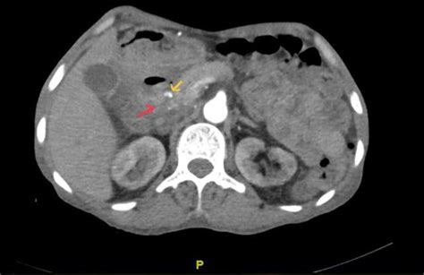 Pseudoaneurysm Of The Gastroduodenal Artery Secondary To Diverticulitis