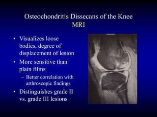 osteocondritis disecante de rodilla juvenil