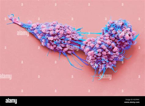 Ovarian Cancer Cells Coloured Scanning Electron Micrograph Sem Of