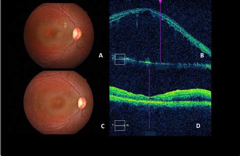 A D Color Fundus Photographs And Sd Oct Scans Of The Right Eye Of The