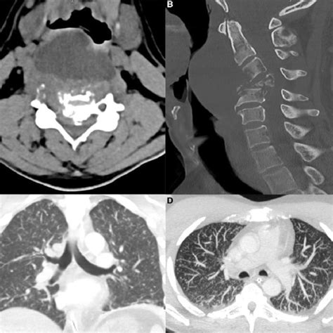 Computed Tomographic Images At The Time Of Admission Noncontrast Axial