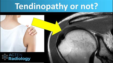 Tendinopathy Tendinosis Of Rotator Cuff Tendons On Mri Youtube