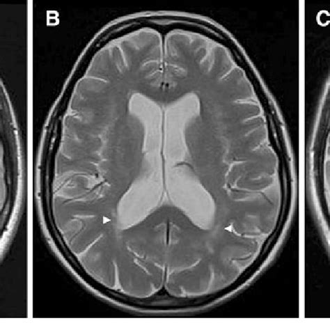 Pdf Association Of Sleep Apnea With Clinically Silent Microvascular