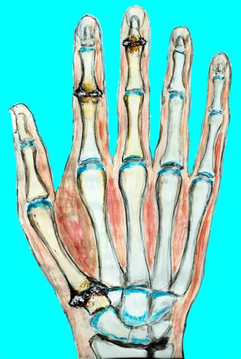 Arthrose An Finger Und Handgelenk Gelenk Gesundheits Blog