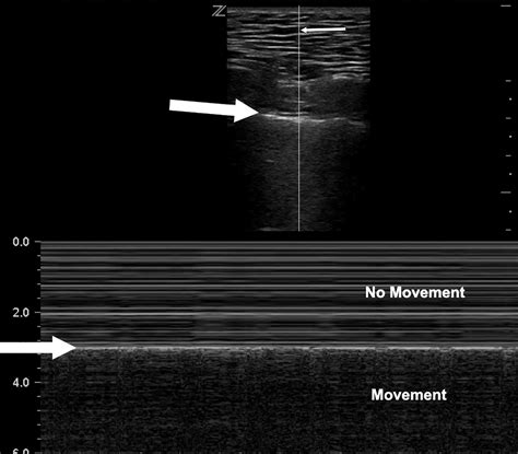 lung ultrasound  practical review  radiologists applied radiology