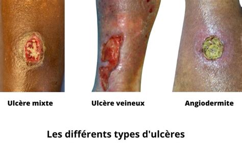 Quels Sont Les Diff Rents Types D Ulc Res Cutan S