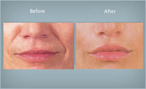 Nasolabial Folds Before And After