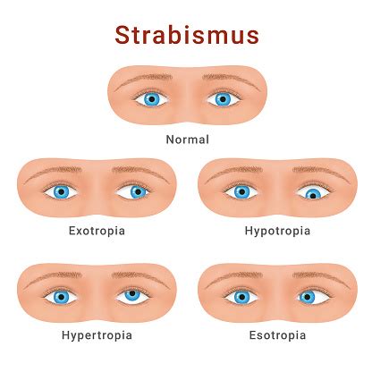 Strabismus Eyes Types Normal Hypotropia Hypertropia Exotropia Esotropia ...