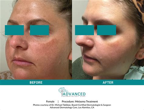 Melasma Treatment2 Advanced Dermatology Care